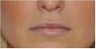 Permalip lip implant for young women that desired permanent and natural lip augmentation
