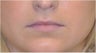 Permalip lip implant for young women that desired permanent and natural lip augmentation