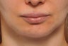 35 Year old Female Treated For Vertically Long Chin