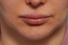 35 Year old Female Treated For Vertically Long Chin