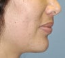 26 Year ld Female Treated For A Weak Jawline