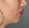 26 Year ld Female Treated For A Weak Jawline