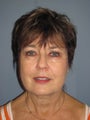 LiteLift™, Platysmaplasty on 64-year-old Woman