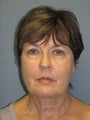 LiteLift™, Platysmaplasty on 64-year-old Woman