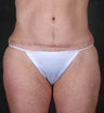 Liposuction of the Hips & Thighs