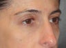 Restylane