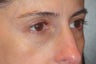 Restylane