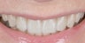 50 year old female wanted a smile makeover