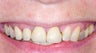 50 year old female wanted a smile makeover