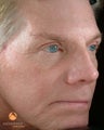 Male Treated with BOTOX® Cosmetic, Perlane® & Sculptra®