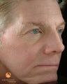 Male Treated with BOTOX® Cosmetic, Perlane® & Sculptra®