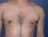Male Breast Reduction Surgery