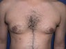 Male Breast Reduction Surgery