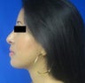 Rhinoplasty and Chin Implant