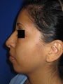Rhinoplasty and Chin Implant