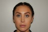 Revision Rhinoplasty