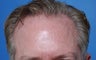 50 year old gentleman treated for hair loss and high hairline