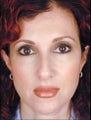 Female Primary Rhinoplasty