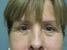 Blepharoplasty, 63 Year Old Female