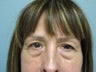 Blepharoplasty, 63 Year Old Female