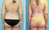 Brazilian Butt Lift Before & After
