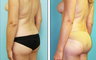 Brazilian Butt Lift Before & After