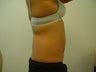 Slim Liposuction to the Abdomen