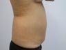 Slim Liposuction to the Abdomen
