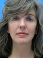 46 yr old woman for Thermage