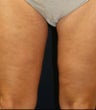 Thighplasty