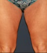 Thighplasty