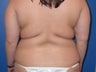 liposuction and buttocks fat grafting