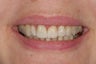 This 50 yearl old patient had her old ceramic crowns on top central inisors repalced with new all cermic crowns.