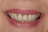 This 50 yearl old patient had her old ceramic crowns on top central inisors repalced with new all cermic crowns.