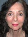 Chin Surgery on 65-year-old