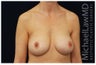 Breast Augmentation