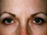 Botox