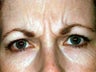 Botox