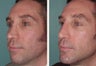 Male Patient, Early 50's Treated for Unnatural Looking Nose