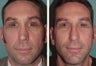 Male Patient, Early 50's Treated for Unnatural Looking Nose