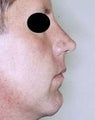 Male patient who underwent nose surgery