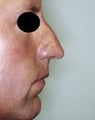 Male patient who underwent nose surgery