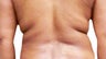 Smart Lipo
