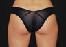 CoolSculpting