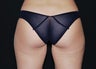 CoolSculpting