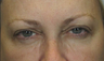 Botox Results