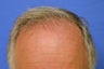 57 year old Male 10 months after Hair Transplantation