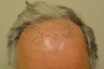 57 year old Male 10 months after Hair Transplantation