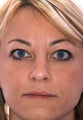 Botox