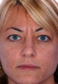 Botox